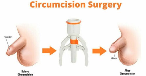 Phimosis STAPLER CIRCUMCISION